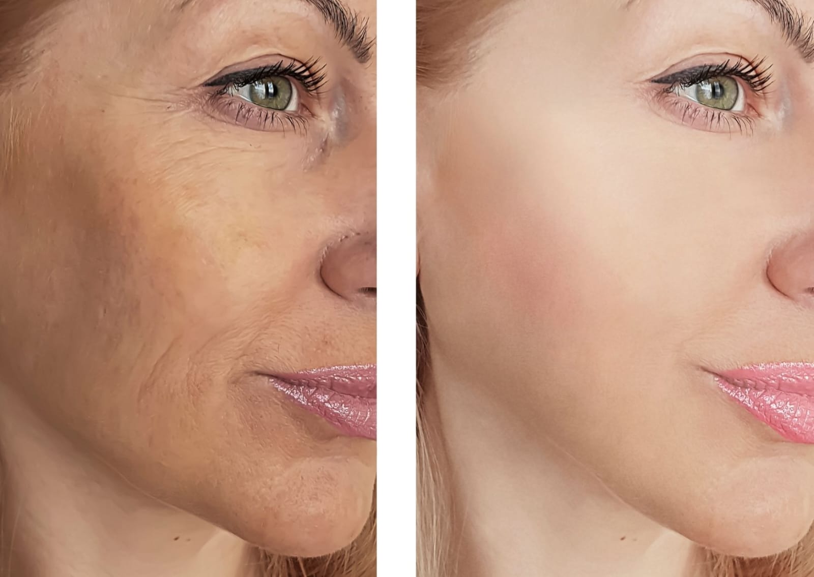 Collagen golden Faden ohne Nadeln